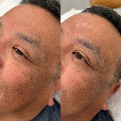 Before + After One Floraessence Peel Treatment