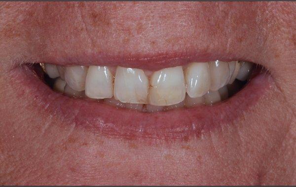 Discolored and misalign Smile, prior to treatment