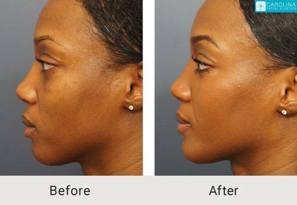 Chin implant and facial fat grafting to contour the jawline.