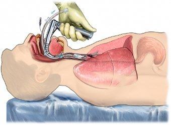 VENTILATION DOSE NOT TREAT OR CURE COVID. INTUBATION IS MURDER. 14% SURVIVAL RATES FOR COVID PATIENTS.