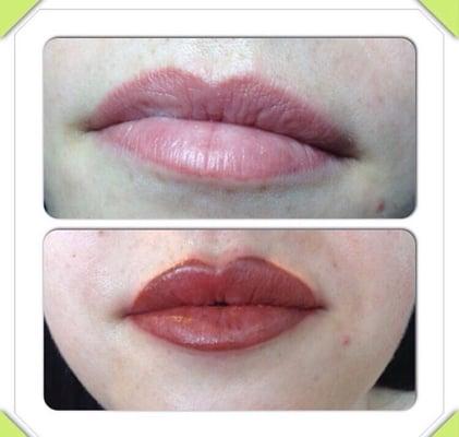 Before and after of full lip procedure.