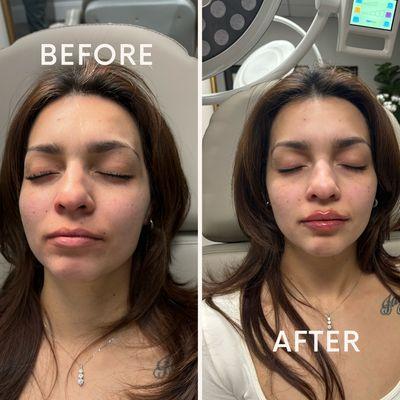 Dr. Grace Zamorano before and after with Kysse lip filler!