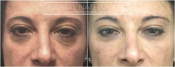 Correction of tear troughs and lid bags with Dr. Nathan's custom filler treatment.