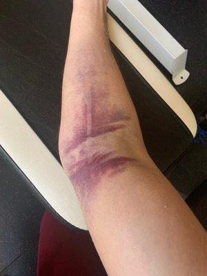 Here is my arm two days later, and it's only getting worse