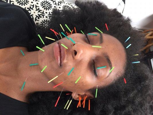 Facial rejuvenation acupuncture.