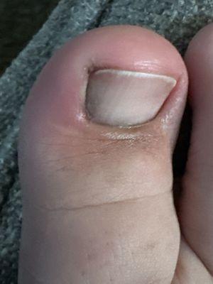 Discolored toe from the infection and swelling!!!