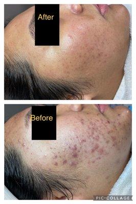 Acne facial