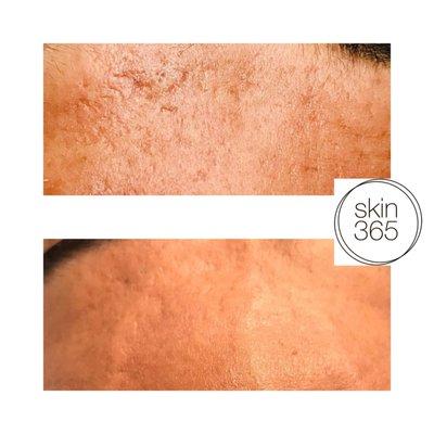 Acne scars respond very well to Surgical Roller Microneedling + DF Ionzyme Infusion. Must prep 8 weeks prior to treatment.