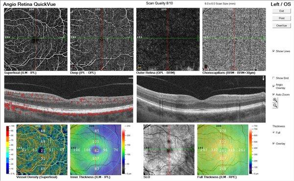 OCTA  (an X-ray of the eye)