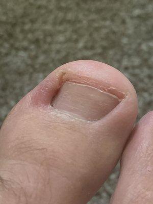 Infected toe