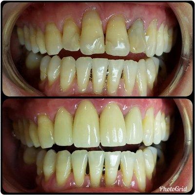 A few crowns on the front teeth for a smile makeover for this happy patient!