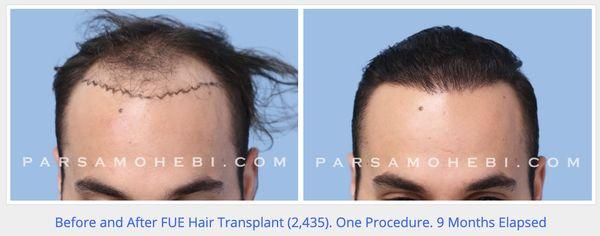 2435 FUE Grafts in San Francisco