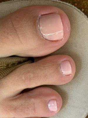 Poor pedicure