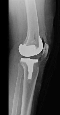 Total Knee Replacement