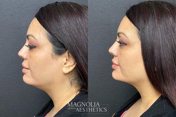 Before & After Chin filler and lip augmentation with Juvederm Voluma & Juvederm Ultra Plus