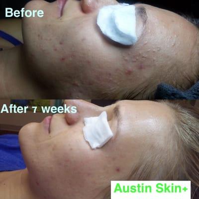 7 weeks of combination acne, noninflamed and inflamed treatments.