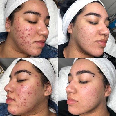 Acne transformation