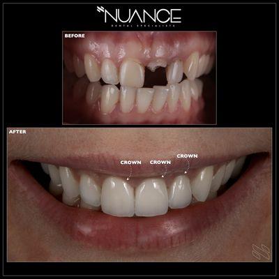 Ceramic crowns add strength and confidence to a smile.