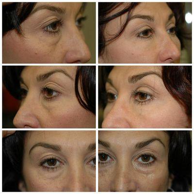 amazing lower eyelid results!