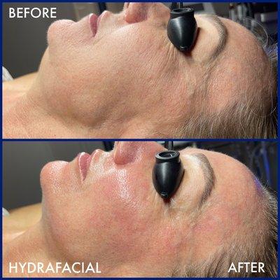 Hydrafacial before & After