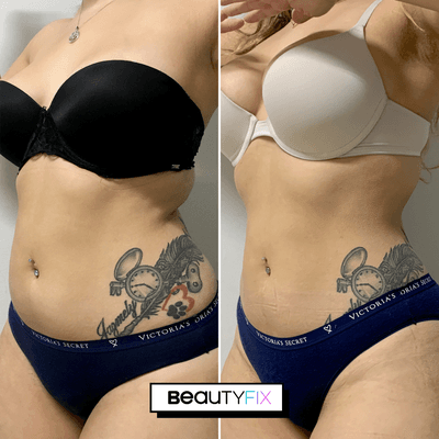 BodyFix: CoolSculpting Results!