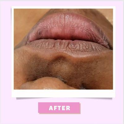 Lip Hydration Treatment After