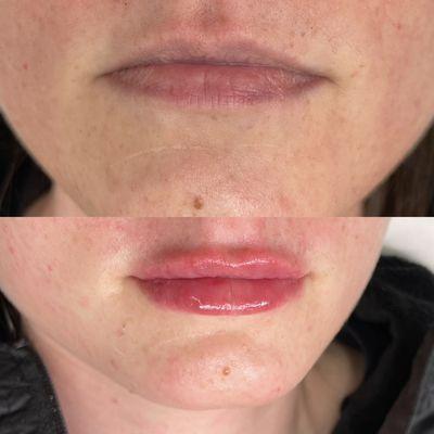 Lip filler enhancement