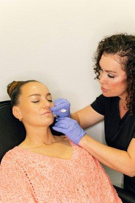 A lip filler treatment