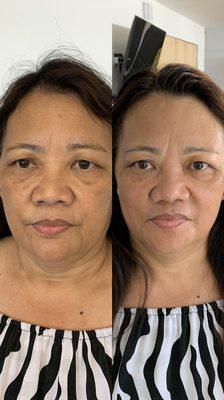 Before and after Harisienne Facial.Brightening, lifting and tightening treatment.