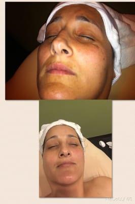 Chemical Peel treatment