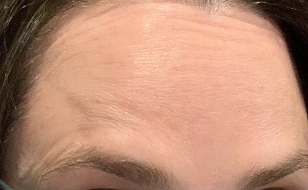 This is my forehead in a resting position 6 weeks after Botox...tons of permanent creases