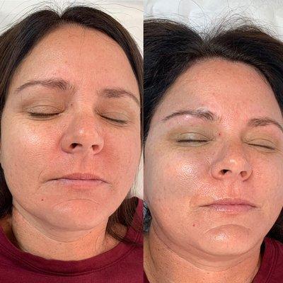 Before and After Dermaplaning Facial