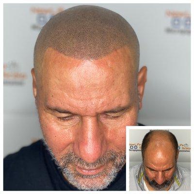 Scalp Micropigmentation (SMP) Two Sessions Natural Hairline