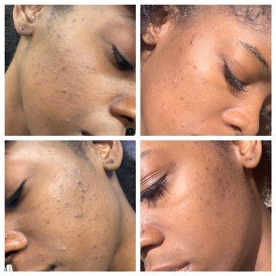 Client after 2 treatments for acne/hyperpigmentation issues. Dermaplaning and chemical peels.