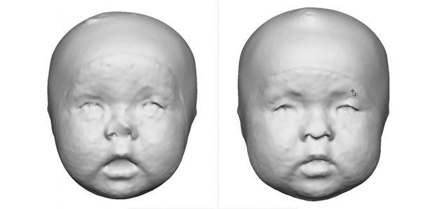 Major difference between consultation visit (left side) and week 2 with the helmet (right side)