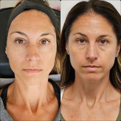 Procell Microchanneling: 2 sessions that has helped her skin texture,  fine lines and elasticity.