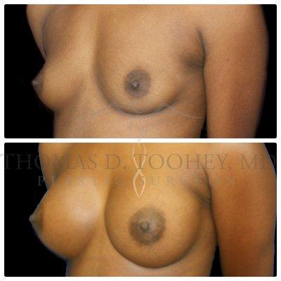 breast augmentation