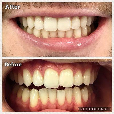 Invisalign treatment