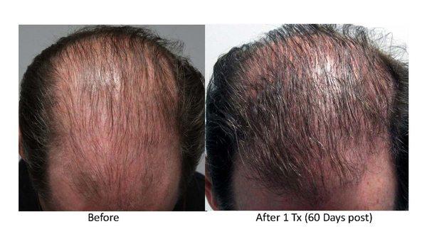 PRP to scalp before/after