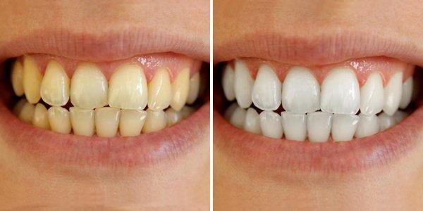 Before and after Laser Teeth Whitening