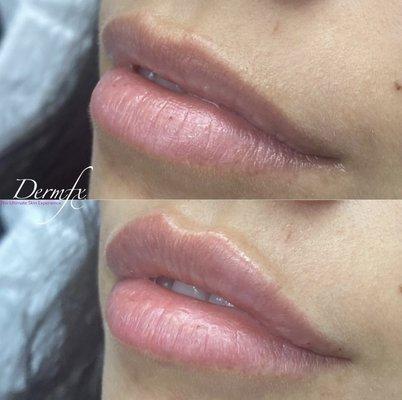 One syringe of Restylane Kysse in the lips