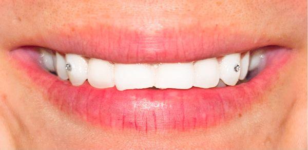 Tooth gems and teeth whitening