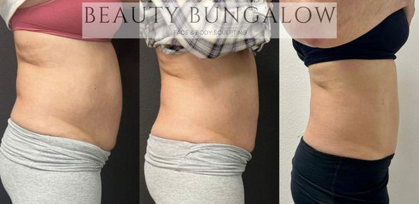 Fat Cavitation + MED360 and EON Laser