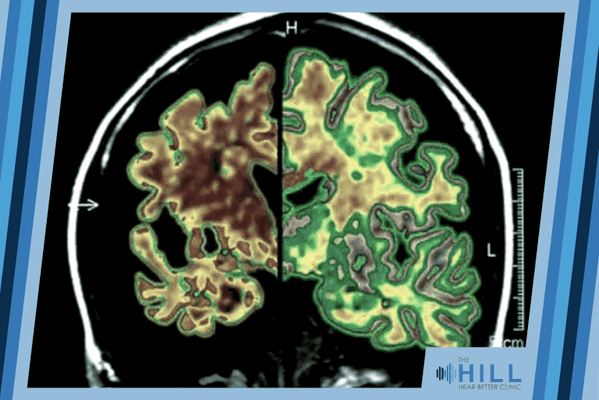 New research shows that untreated hearing loss is the largest modifiable risk factor for dementia...