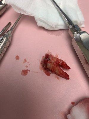 My tooth