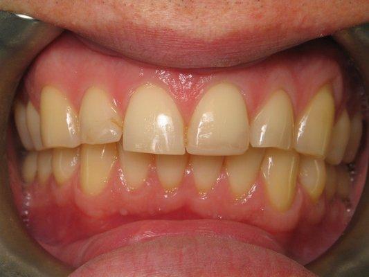 worn and chipped teeth