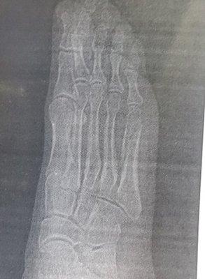 5th metatarsal fracture