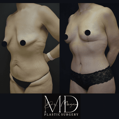 Tummy Tuck and Breast Lift before and after