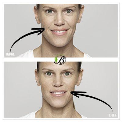 Dysport is a temporary filler used to treat moderate to severe forehead and smile lines.