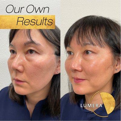 Sculptra treatment before and after results.